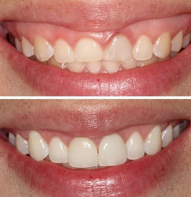 Cirurgia Plástica Gengival